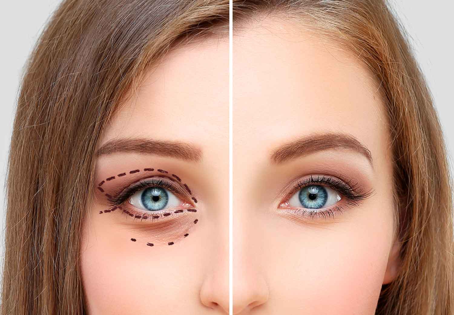 blefaroplastia-parpados-caidos